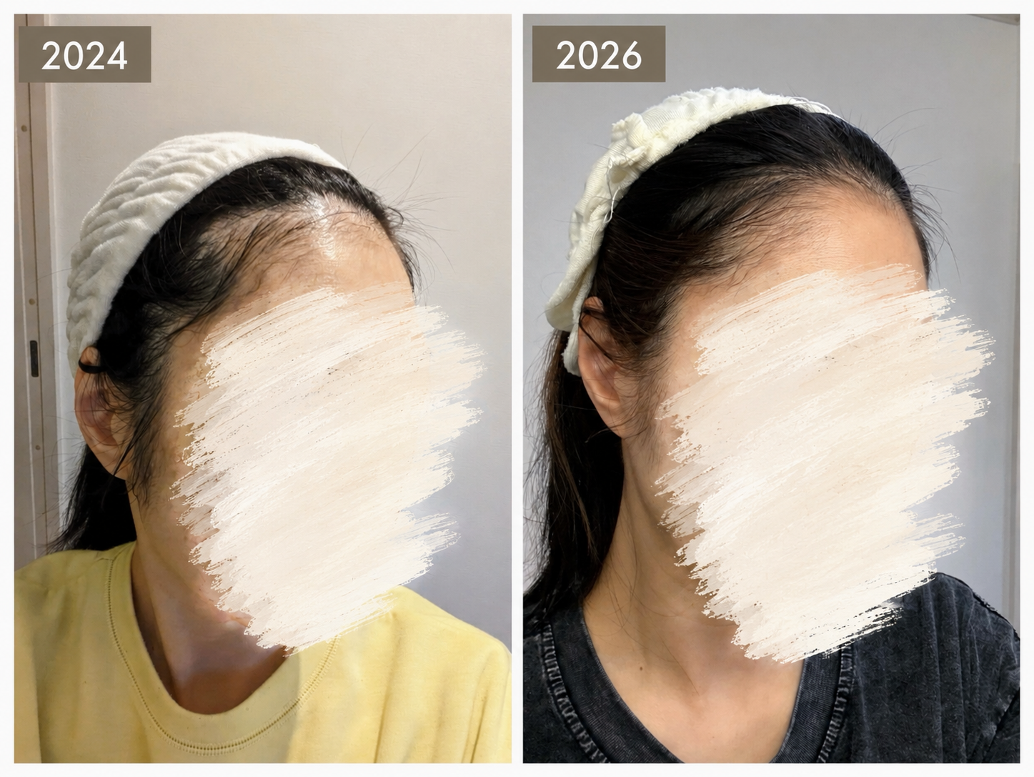 前髪の生え際の比較写真。左が2024年、右が2026年